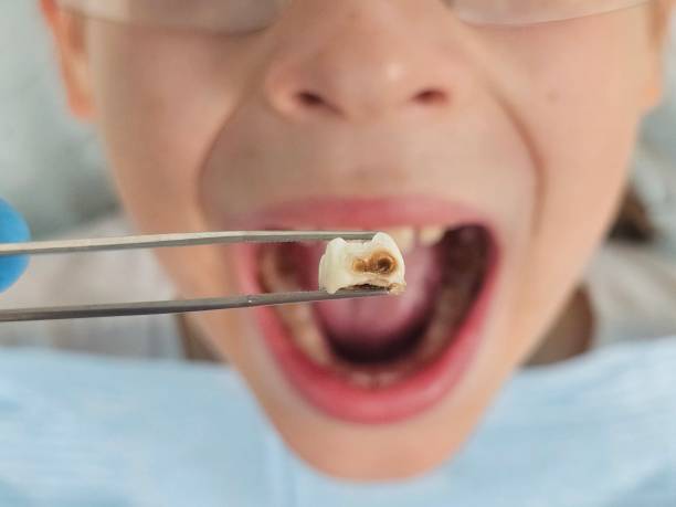 Best Emergency Dental Care for Broken or Chipped Teeth in Mahomet, IL